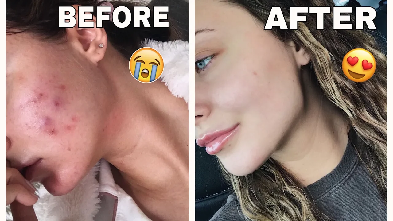 
          
          
          
            
            HOW I CLEARED MY SKIN IN 30 DAYS *naturally*
          
        . 