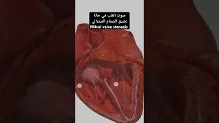 صوت القلب عند تضيق الصمام الميترالي  صوت القلب عند تضيق الصمام الميترالي