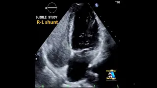 Bubble test agitated saline positive R-L Shunt