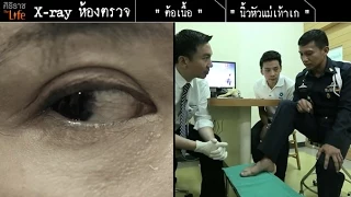 วิธีเลือกซื้อรองเท้าที่เหมาะสมเพื่อป้องกันโรคเท้าอย่างไร