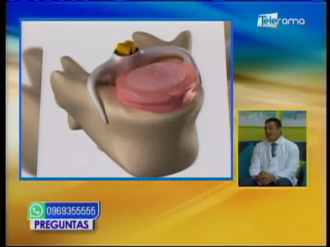 Hernia discal