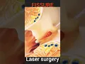 Fissure Treatment Laser Surgery