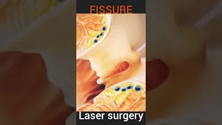 Fissure Treatment Laser Surgery