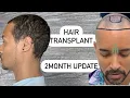 Download Lagu Hair Transplant 2 month Update