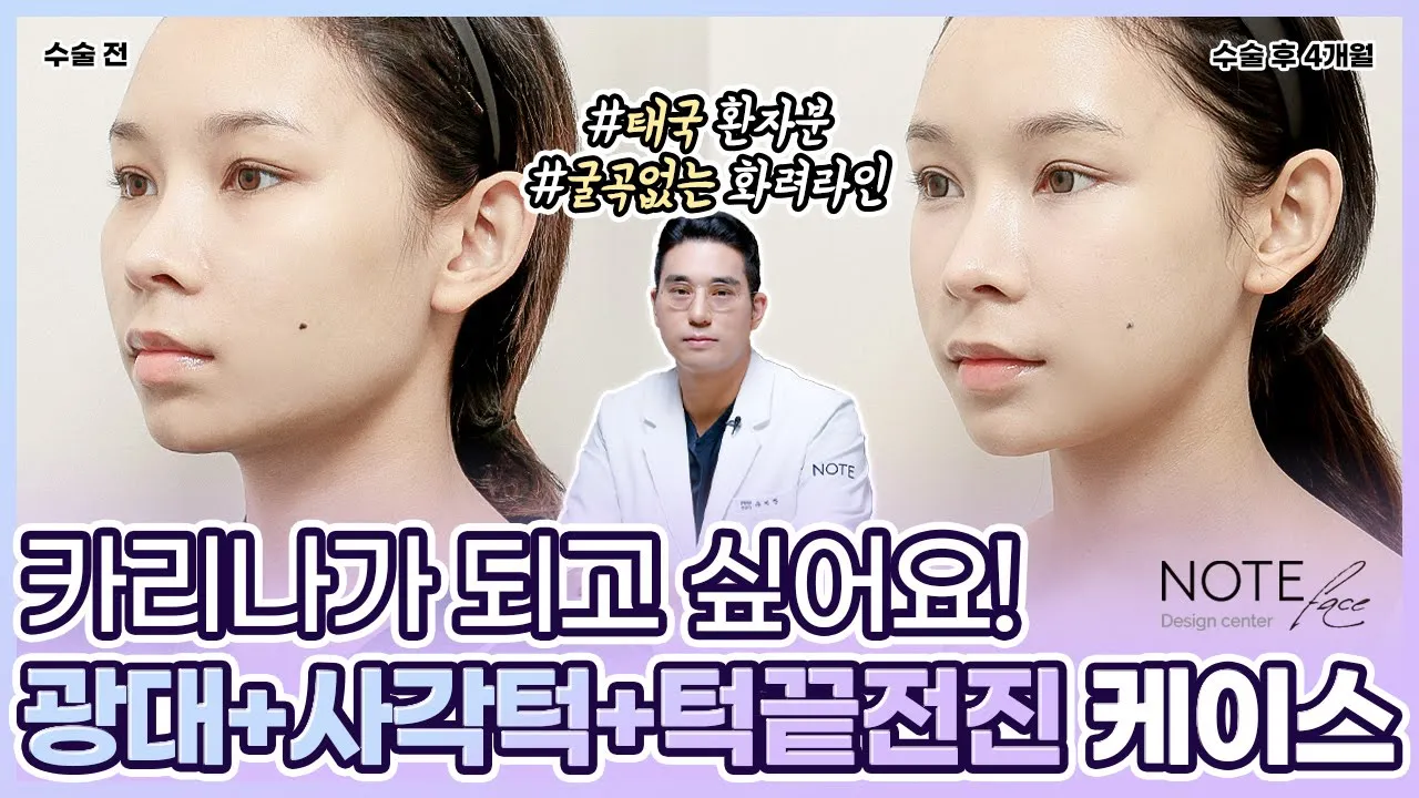 [유.케.리] 📍 CT로 보는 케이스 리뷰 l 화려한 인형 라인 l 광대 + 사각턱+ 앞 턱 l 태국인 환자분 l