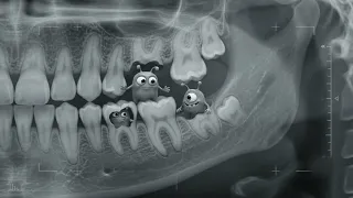 Inside a Child s Tooth The Secret World of Tooth Bugs Realistic Dental X-Ray Animation 4K