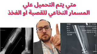 متي يتم التحميل علي الساق بعد تركيب المسمار النخاعي   دندنها