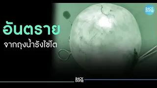ถุงน้ำรังไข่มีกี่ชนิด และชนิดไหนเสี่ยงต่อการเป็นมะเร็งมากที่สุด