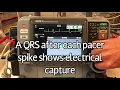 LifePak 15 - Transcutaneous Pacing