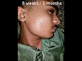 Download Lagu My Minoxidil 5% Journey: Shocking Before and After Transformation Revealed #minoxidil5