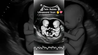 Twin Babies Moving in Mother s Womb Real Ultrasound View