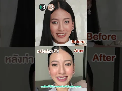 รีวิวยกกระชับหน้า ด้วย Ultraformer III ที่ B Clinic