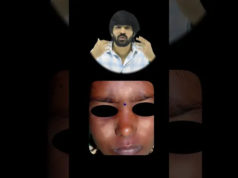 White Spot on Face