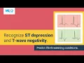 Download Lagu Simplifying ST depression and T-wave negativity