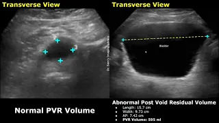 Download Pre Void \u0026 Post Void Residual Volume Bladder Ultrasound Normal Vs Abnormal Images | PVR USG MP3