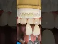 Download Lagu Monet Pure Zirconia Incisors #lsk121shorts #dentist #teeth