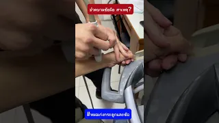  ทำไมข้อมือถึงมีก้อนนูนและเจ็บเวลาจับหรือขยับ 