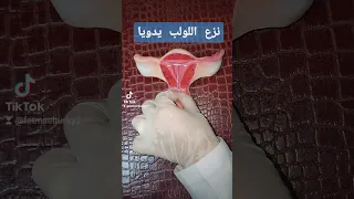  طريقة  نزع اللولب بدون ألم بدون منظار ويدويا  د فاطمة التركى  استشارى  النساء  الولادة دندنها