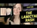 hell on earth the lamictal rash STORYTIME