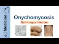 Onychomycosis Nail Infection Signs Symptoms Treatment