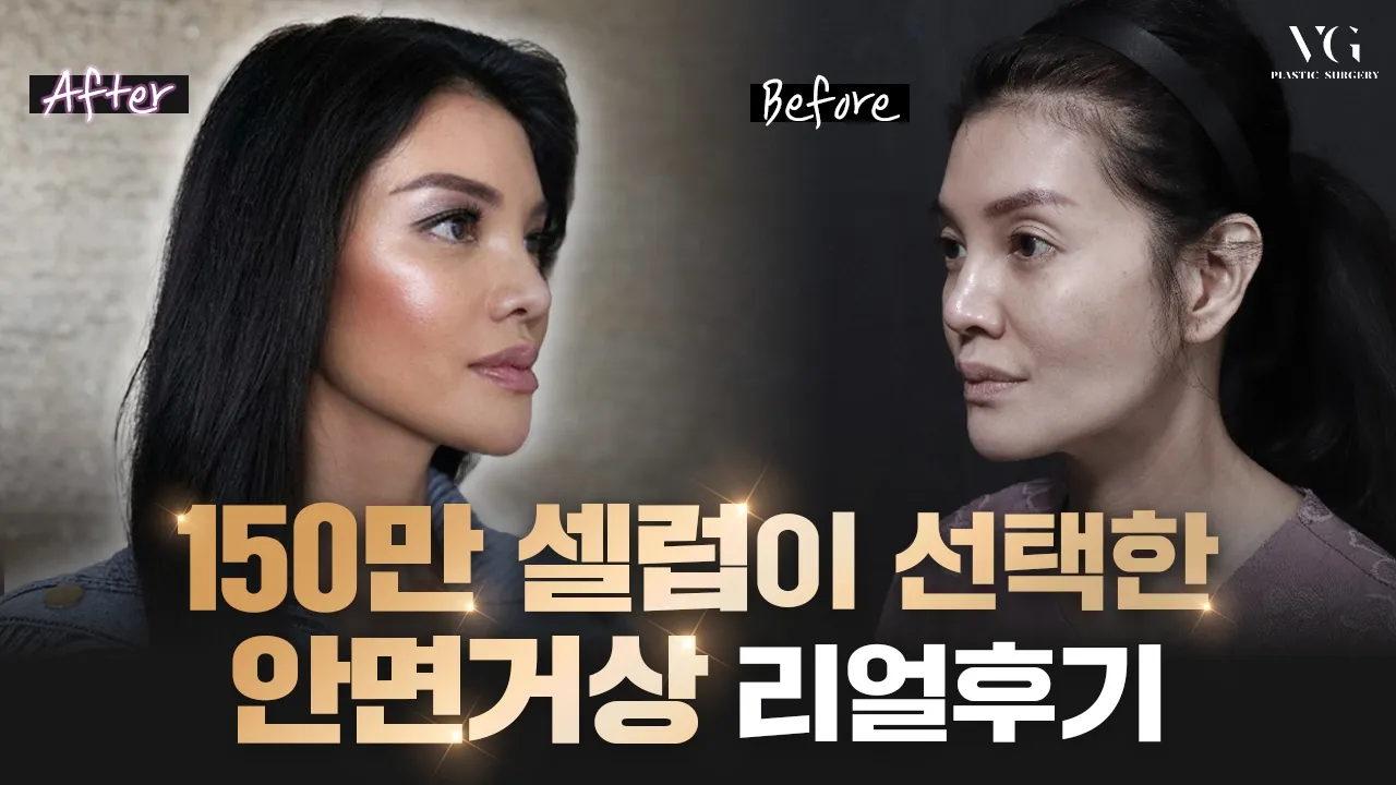 전 세계가 주목한 셀럽 '파라퀸', 한국에서 안면거상 받은 리얼후기