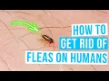 Download Lagu How to GET RID OF FLEAS ON HUMANS