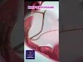 ERCP Procedure for Bile Duct Obstruction Removal