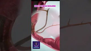 ERCP Procedure for Bile Duct Obstruction Removal
