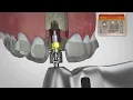 BioHorizons Pro Surgical Kit Drilling Sequence Keyless Guided Surgery