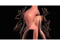 What Killed Lindsey Graham Aortic Dissection