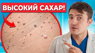 Как кожа предупреждает о ПРОБЛЕМАХ С САХАРОМ! Нельзя игнорировать