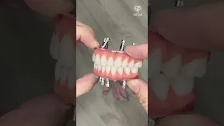 طقم الأسنان الثابت على 4 زرعات فقط 