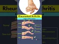 Download Lagu Rheumatoid Arthritis Finger Deformities Explained | Swan Neck, Boutonniere \u0026 Mallet Finger