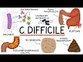 Lagu Understanding Clostridium Difficile Infection (C. Diff)