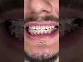 Braces Colors that make your teeth look Whiter