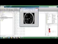Lung Pattern Classification for Interstitial Lung Diseases Final Year Projects 2016 - 2017