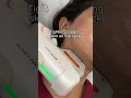 Lagu Double Chin Reduction - enjoy a more defined jawline with HIFU