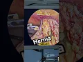 Download Lagu OBSTRUCTED Hernia UMBILICUS I Treatment I Umbilical Hernia Surgery I India I Gujarat I Operation