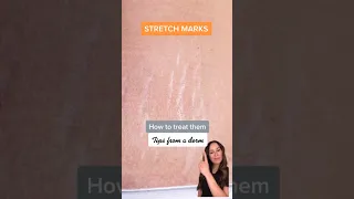 How To Treat Stretch Marks - Tips From A Derm
