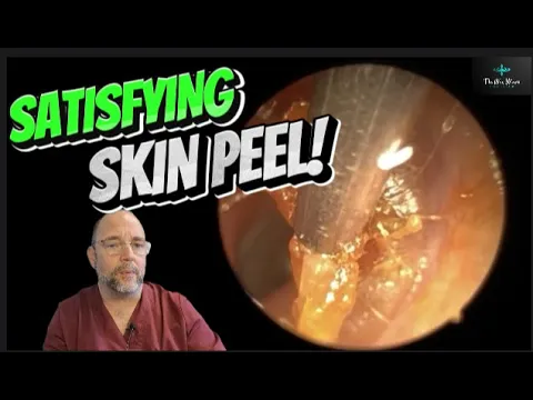 Download MP3 SATISFYING SKIN PEEL!268 #ear #earwax #earwaxremoval #earcleaning #fyp #asmr #asmrearwax #satisfying