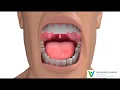 Oral Cancer - What Is It What are the Symptoms and Treatment