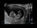 Download Lagu Scan of the Week: 12 Week Advanced Early Scan