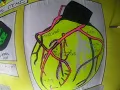 ENG LATERAL STEMI