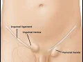 Repair Femoral Hernia CPT code - simplify medical coding
