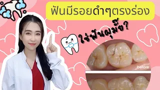 รอยดำที่ร่องฟันเกิดจากอะไร และต้องทำอย่างไรบ้าง