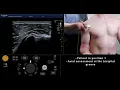 Ultrasound Tutorial MSK Series Shoulder Rotator Cuff Radiology Nation