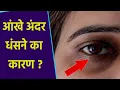 Download Lagu Reasons for sunken eyes | Why do eyes sunken in? Boldsky