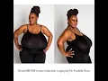 Biggest Natural Breasts In Texas Houston Breast Reduction Surgery