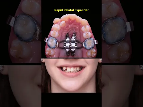 The rapid palatal expansion (RPE) process using an orthodontic appliance before braces installation