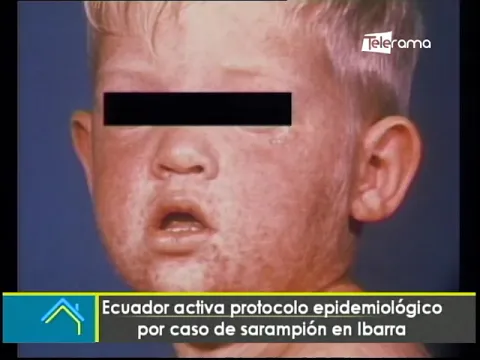 Ecuador activa protocolo epidemiólogo por caso de sarampión en Ibarra